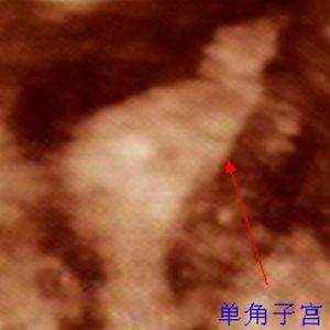 单角子宫
