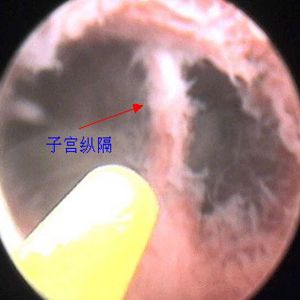 子宫纵隔