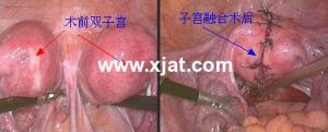 子宫融合