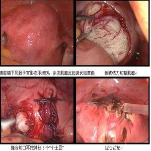 子宫肌瘤图片