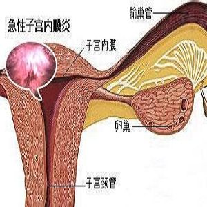 子宫内膜炎