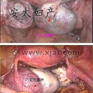 卵巢巧克力囊肿