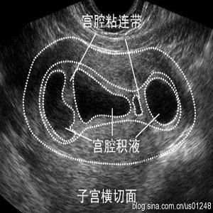 宫腔粘连