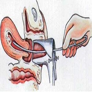 宫腔粘连