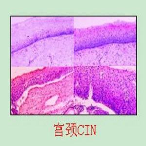宫颈CIN