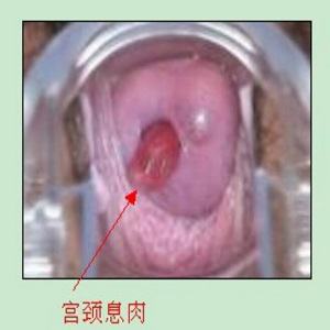 宫颈息肉
