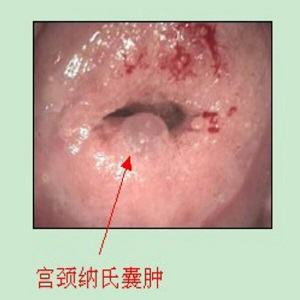 宫颈纳囊
