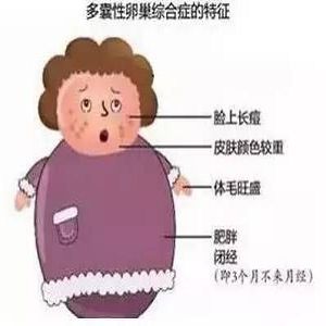 多囊卵巢