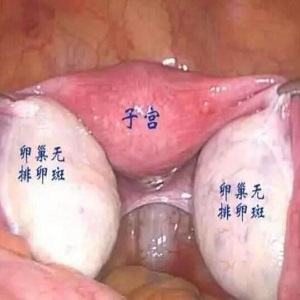 多囊卵巢