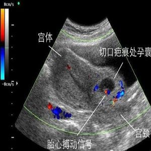 疤痕子宫妊娠