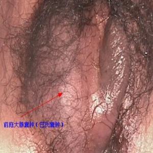 前庭大腺囊肿/巴氏囊肿