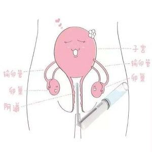 阴道换菌