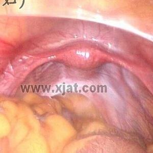 阴毛少,低促性腺性功能减退