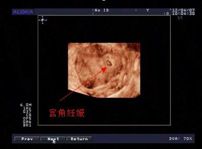 子宫角妊娠