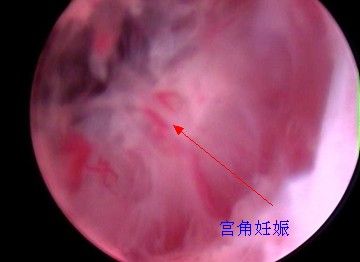 宫角妊娠