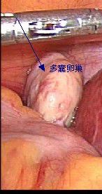 多囊卵巢