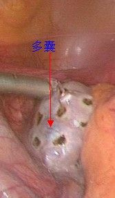 多囊卵巢