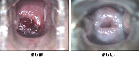 宫颈糜烂