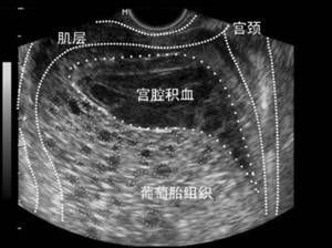 葡萄胎