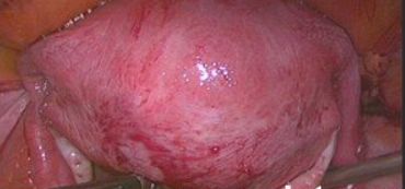 腺肌症,盆腔粘连