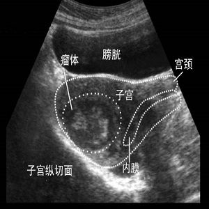 子宫肌瘤B超检查