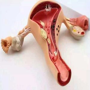 腺肌症