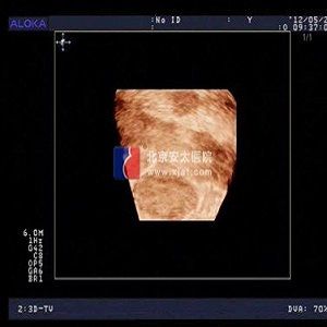 石女彩超检查
