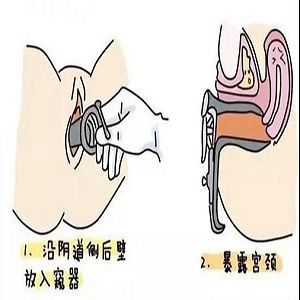 子宫脱垂