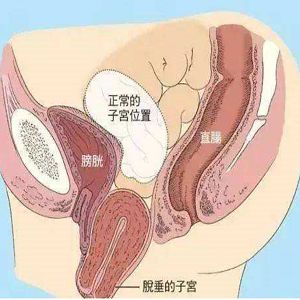 子宫脱垂