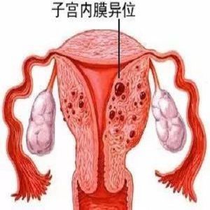 子宫内膜异位