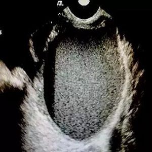 子宫内膜异位B超检查