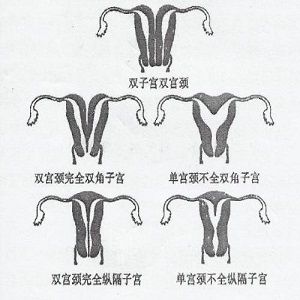 子宫畸形