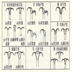 子宫畸形