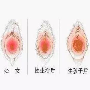处女膜修复