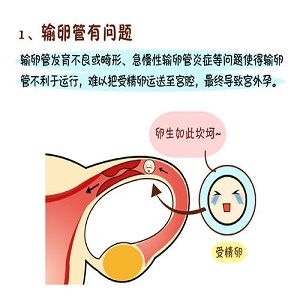 输卵管先天性发育不良