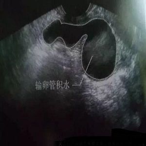 输卵管积水