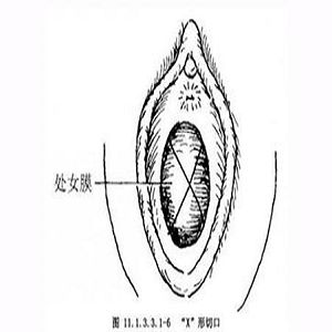处女膜闭锁症状