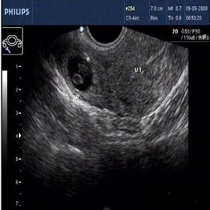 宫外孕B超检查