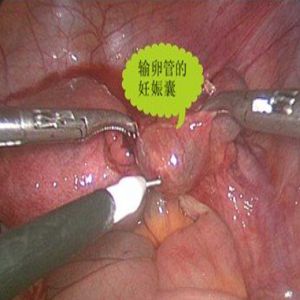 宫外孕输卵管妊娠