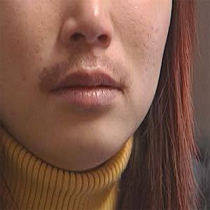 多囊卵巢长胡须