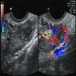 子宫肌瘤容易发生恶变吗？