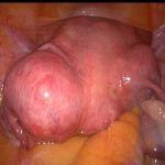 【414】子宫肌瘤保宫治疗