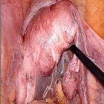 两镜一丝，输卵管鼠——治疗输卵管堵塞性不孕