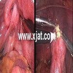 结核性不孕腹腔镜术后成功怀孕