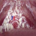 阴道炎-小病也是大麻烦