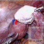 多囊卵巢病的对因治疗