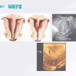 习惯性流产与子宫纵隔