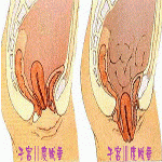 盆底松弛综合征概述