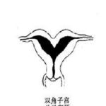 双角子宫和马鞍子宫