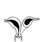 单角子宫和残角子宫